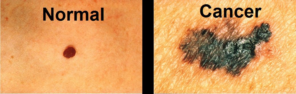 How To Identify Cancerous Moles