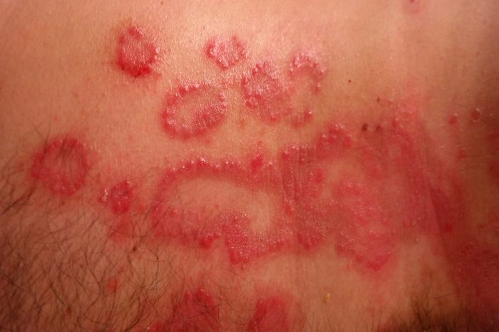 Rashes affecting the lower legs | DermNet New Zealand