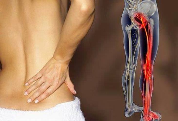 sciatica exercises