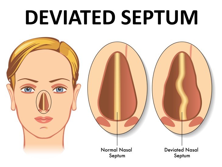 Chronic Sinusitis Causes deviated septum