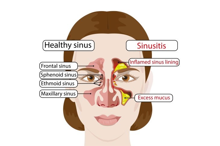 Chronic Sinusitis Causes