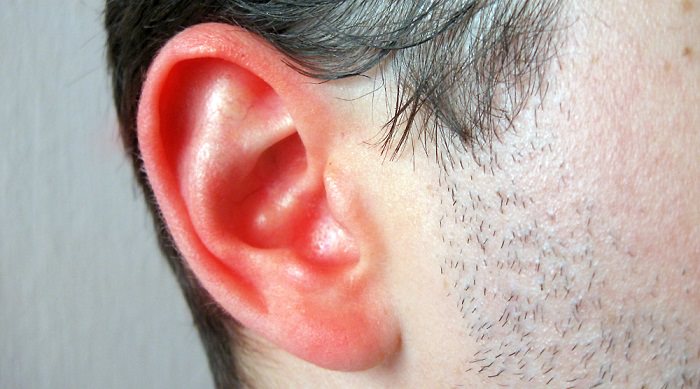 The Natural Way of Eliminating an Earache