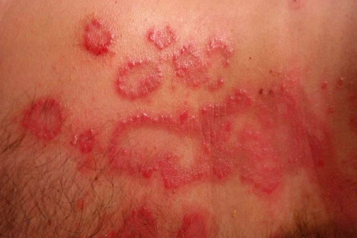psoriasis on skin