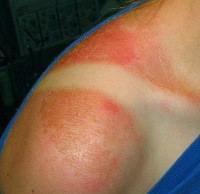 Get Rid of Sunburn in 3 Easy Steps