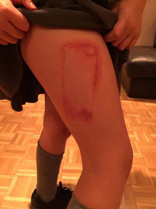 School Girl Suffers Third Degree Burns from iPhone