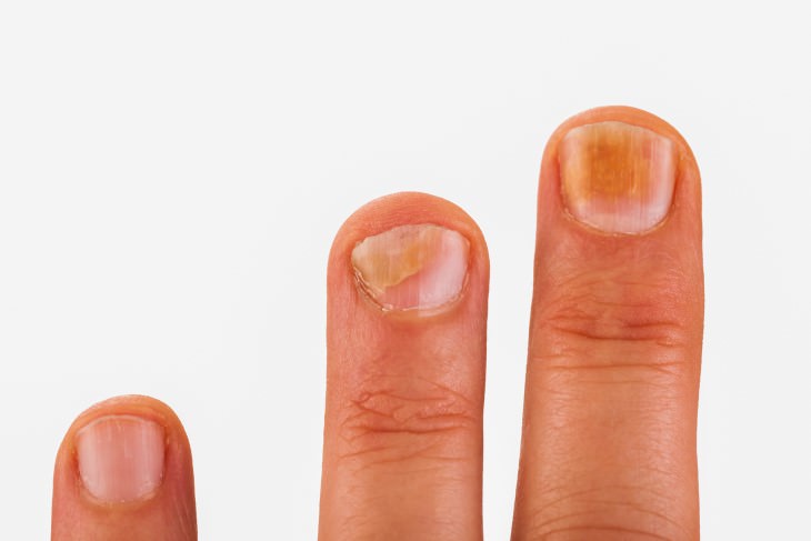 health problems fingernails