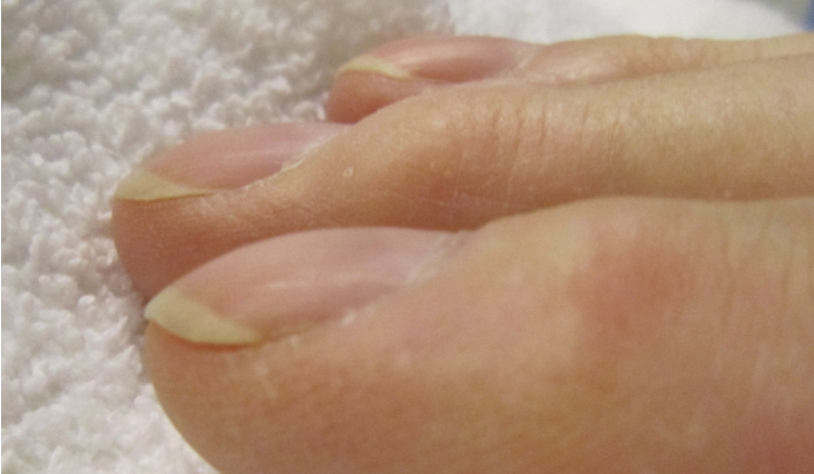 curved fingernails health warning