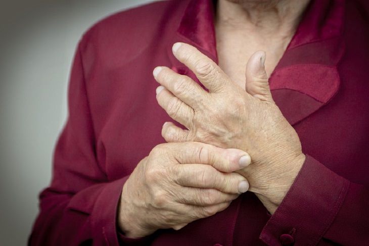 aerobics help arthritis, photo of hands with arthritis 