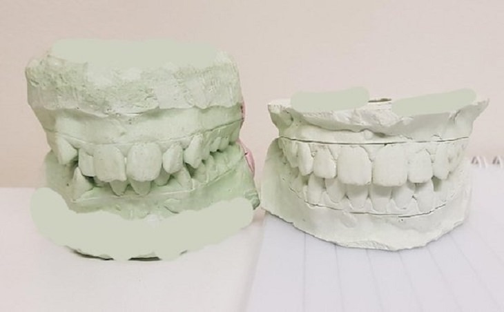 difference in comparison of random things, two plasters of the same teeth showing before and after braces