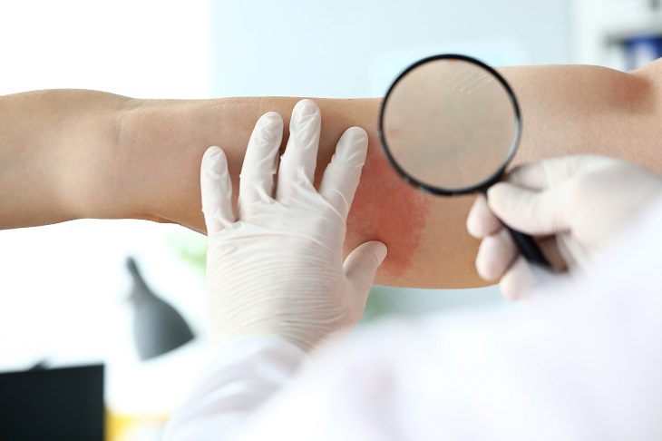 keratosis pilaris treatment, doctor examining red skin on persons arm through magnifying lens