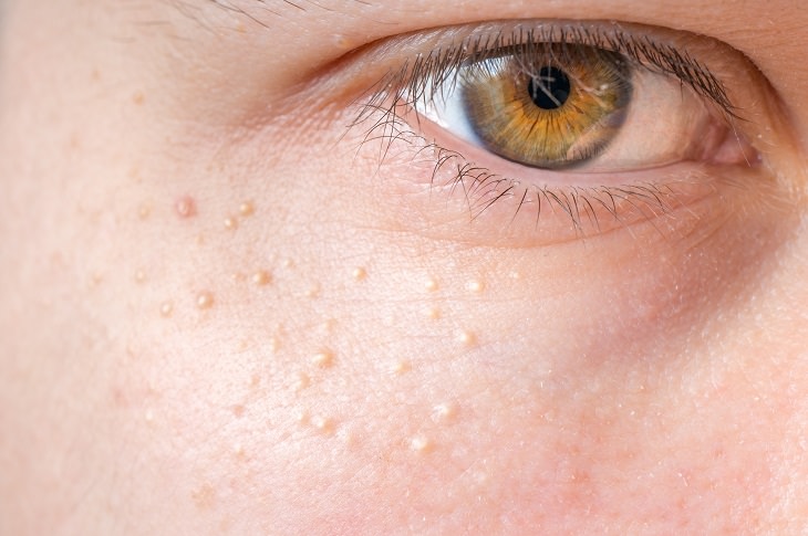 keratosis pilaris, close-up of an eye with small bumps underneath the eye
