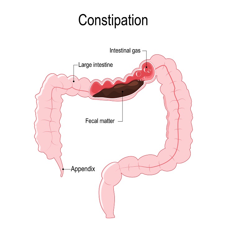 treating the sensation and issue of incomplete bowel movements, illustration of constipation