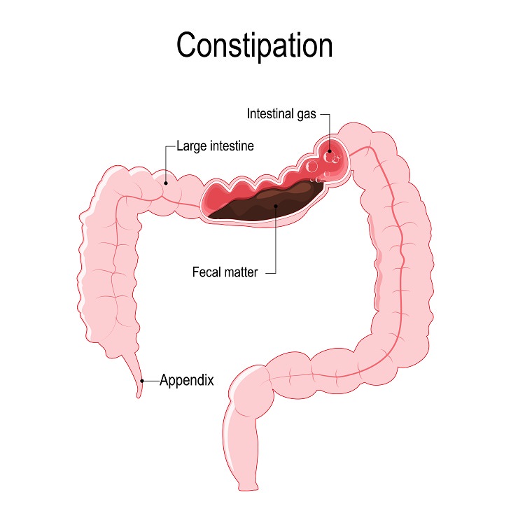 How to cure the incomplete bowel movement - Quora