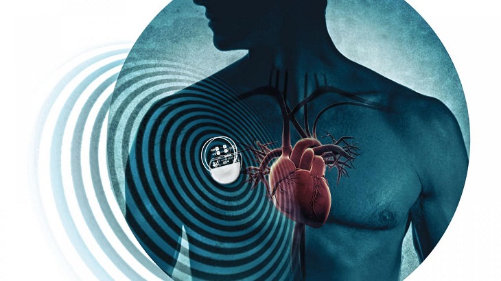 Artificial Neurons PACEMAKERS