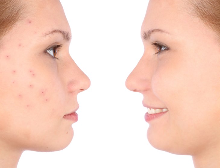 cranberries woman with and without acne