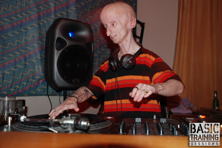 Progeria diseases, ailments, illnesses, rarest,