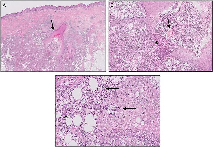 Information on Hidradenitis Suppurative, Acne Inversa, HS, Skin disease, micrograph of HS progression and development showing different stages