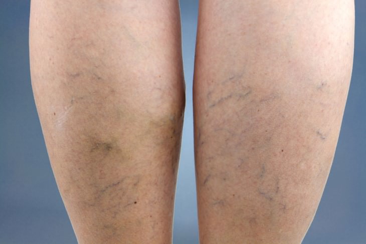 vericose veins