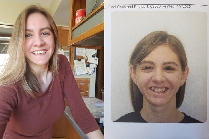 Amazing photographs that show differences, shapes and sizes through comparison, Before and after wearing braces for 9 years