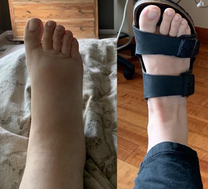 Amazing photographs that show differences, shapes and sizes through comparison, A mother’s ankle two days prior to giving birth and two days after