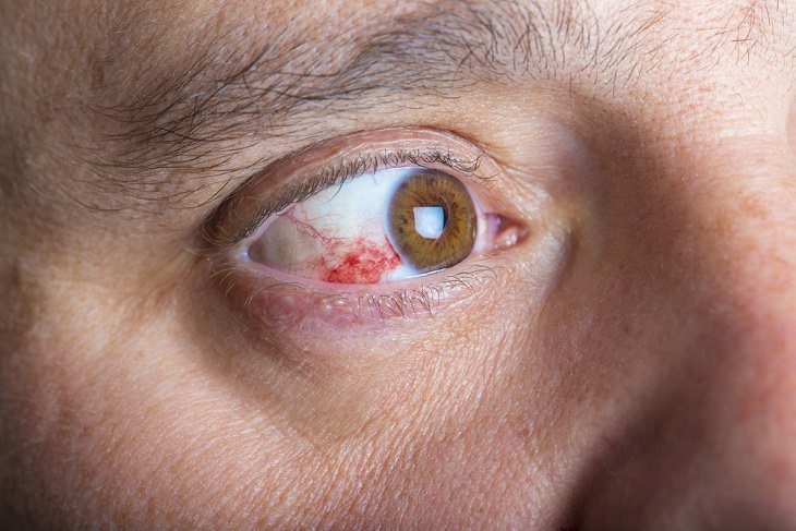 Pink eye, COVID-19 Symptoms