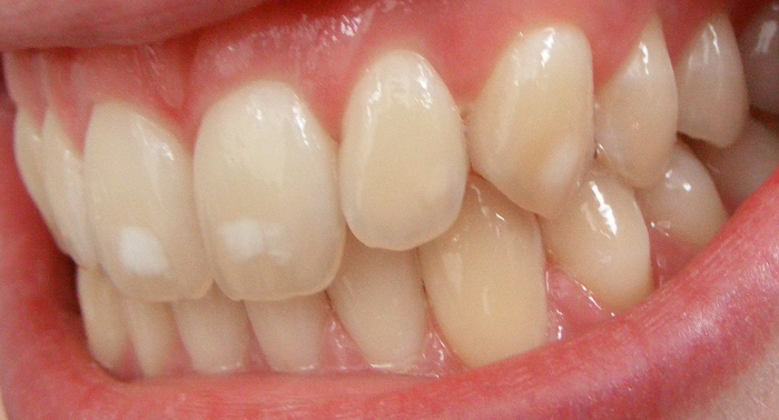 Pasta De Dientes Con Fluoruro vs Sin Fluoruro, fluorosis