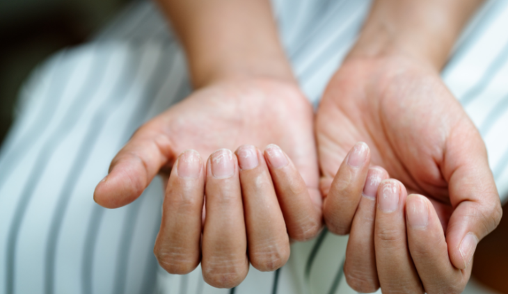 brittle nails