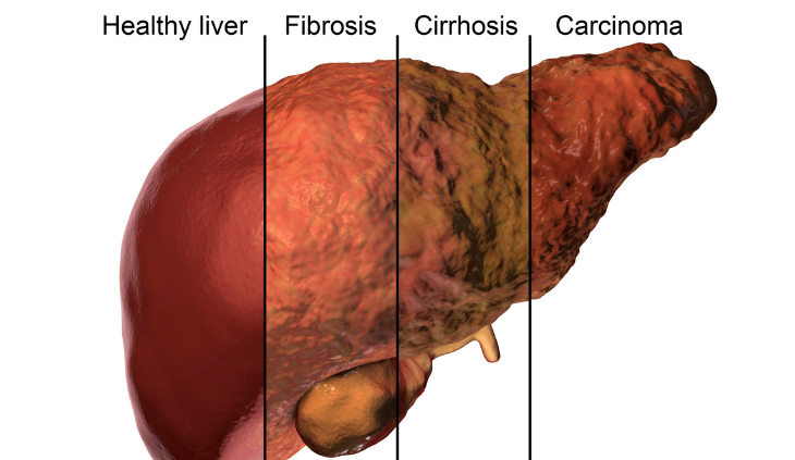 fatty liver progression