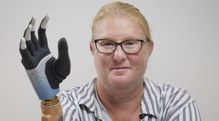 Karin with prosthesis hand