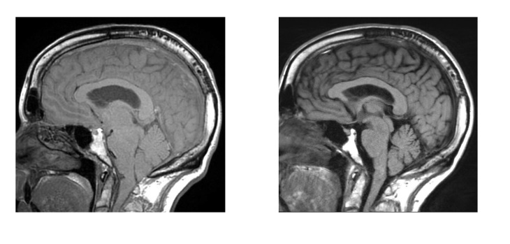 On the Left: An image of brain sagging. On the right: Post-op resolution of brain sagging. Credit: Cedars-Sinai Medical Center