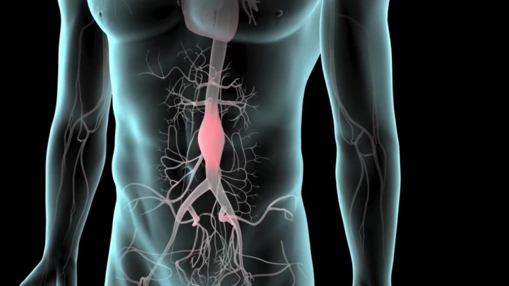 abdominal aortic aneurysm