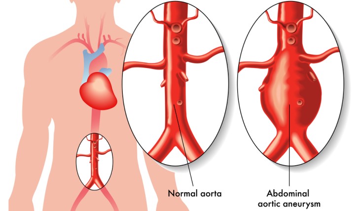 abdominal aortic aneurysm