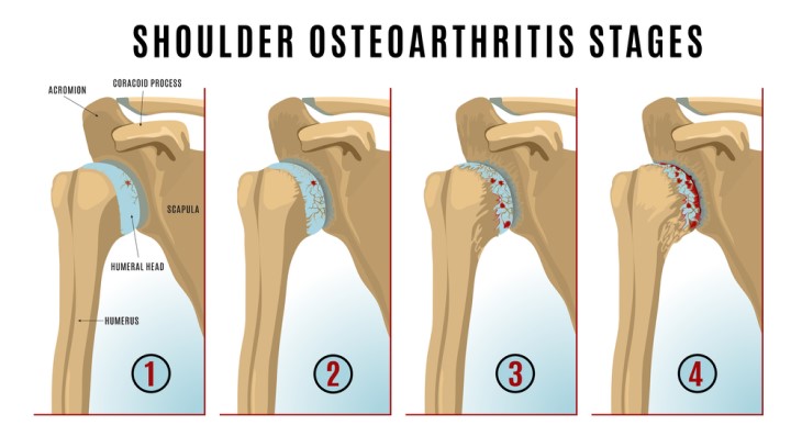 shoulder osteoathritis