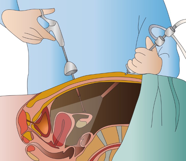 ilustração de cirurgia laparoscópica