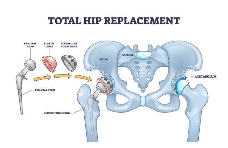 hip replacement