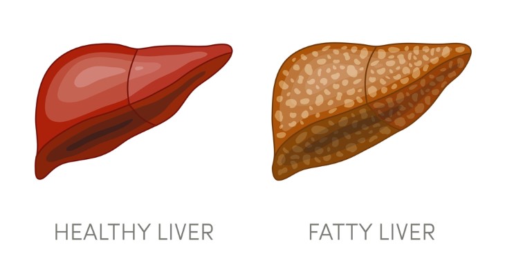fatty liver