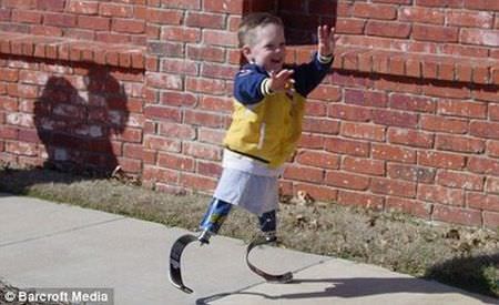 child with artificial legs