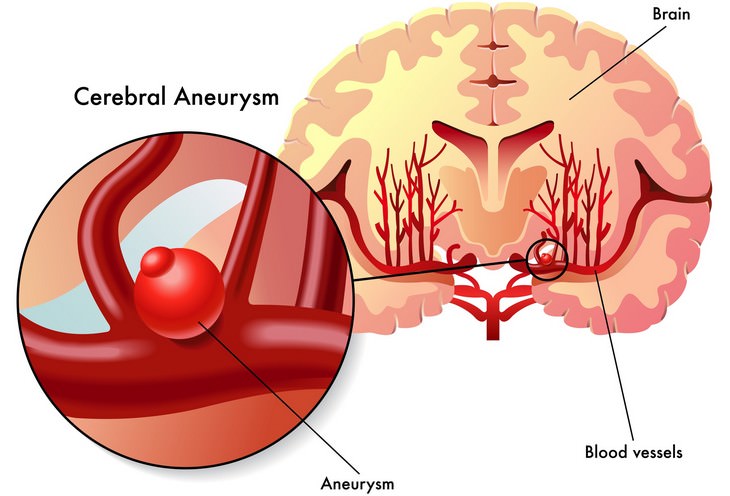 brain aneurysms