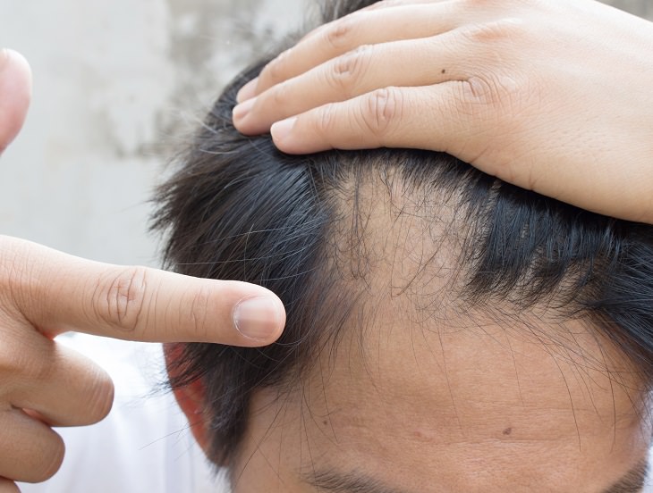 Alopecia Areata - Informative - Helpful