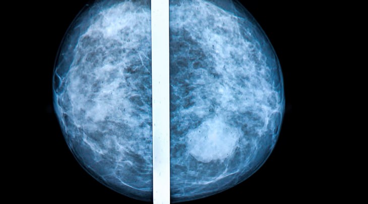 breast cancer, not cancer, check-up