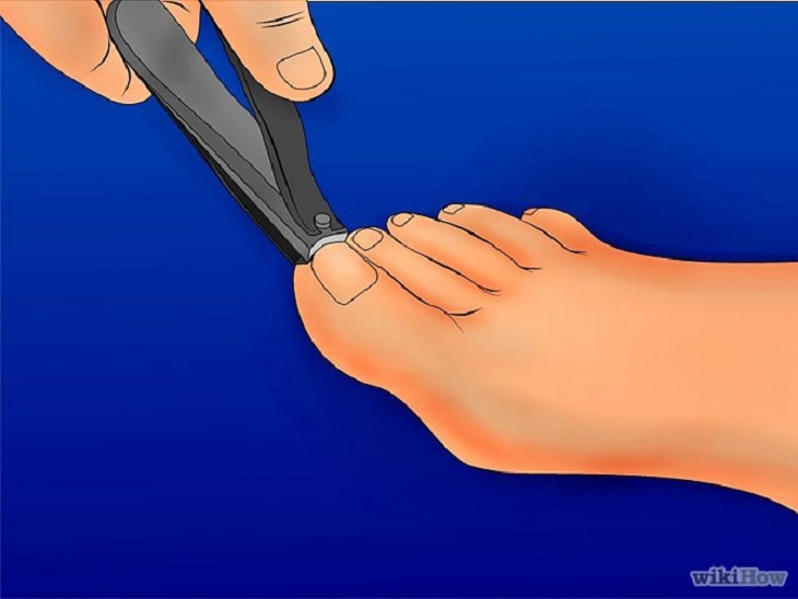 Treatment - Ingrown - Toenails