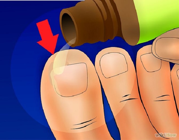 Treatment - Ingrown - Toenails