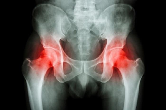Back pain hip xray