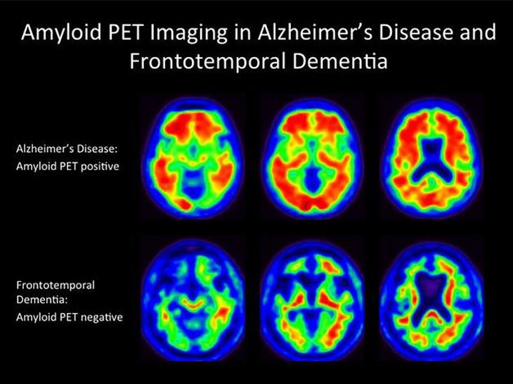 Amazing: Researchers Make Massive Alzheimer's Breakthrough