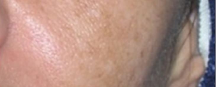 melasma