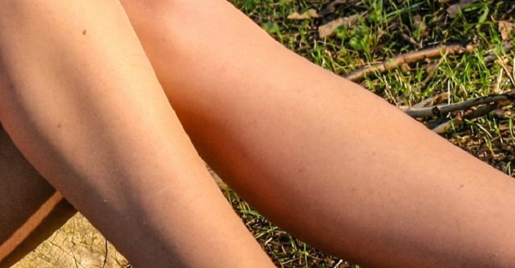 nice legs, eczema