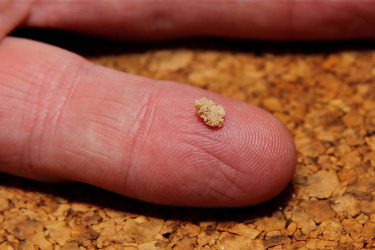 Could This Research Consign Kidney Stones To History?