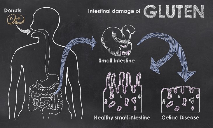 Cope - Celiac Disease