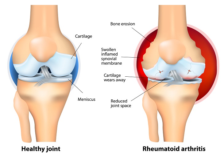 achy joints