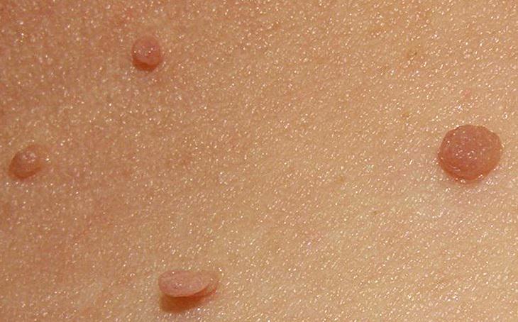 Remove Skin Tags with This Wonderful Natural Remedy